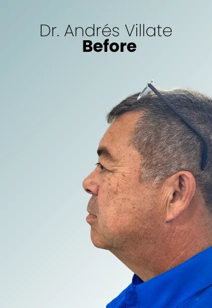 Face Lift Procedure Img10 Queen Catalina