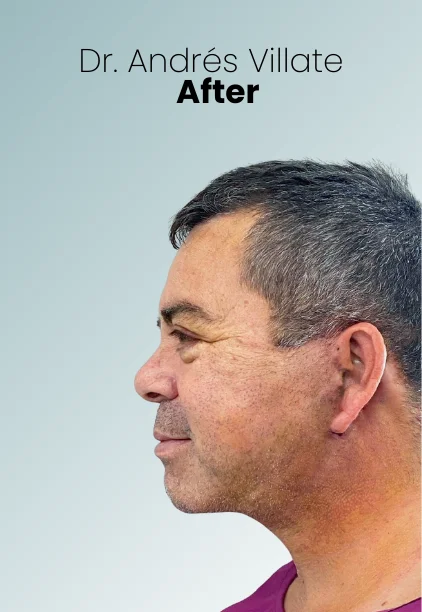 Face Lift Procedure Img11 Queen Catalina