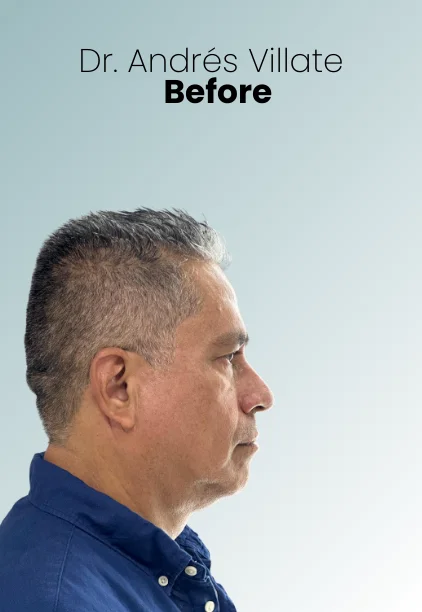 Face Lift Procedure Img13 Queen Catalina