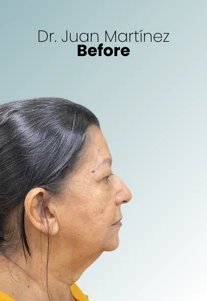 Face Lift Procedure Img18 Queen Catalina