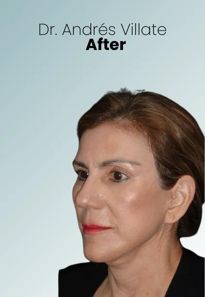 Face Lift Procedure Img3 Queen Catalina