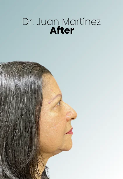 Face Lift Procedure Img4 Queen Catalina