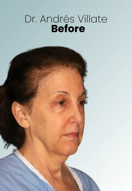 Face Lift Procedure Img6 Queen Catalina