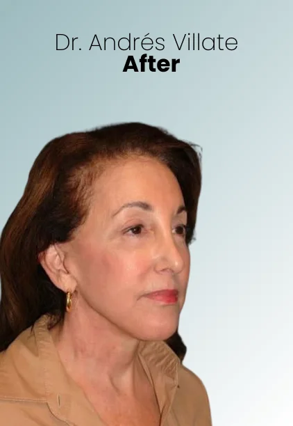 Face Lift Procedure Img7 Queen Catalina