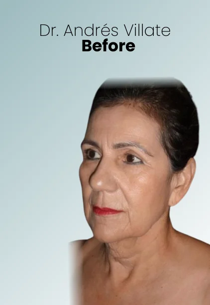 Face Lift Procedure Img8 Queen Catalina