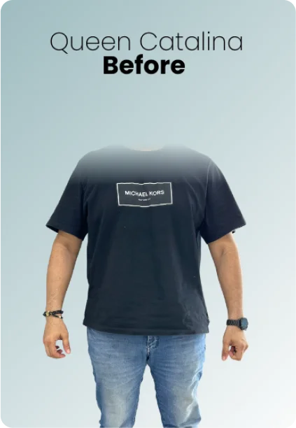 Gastric Balloon Procedure Img2 Queen Catalina