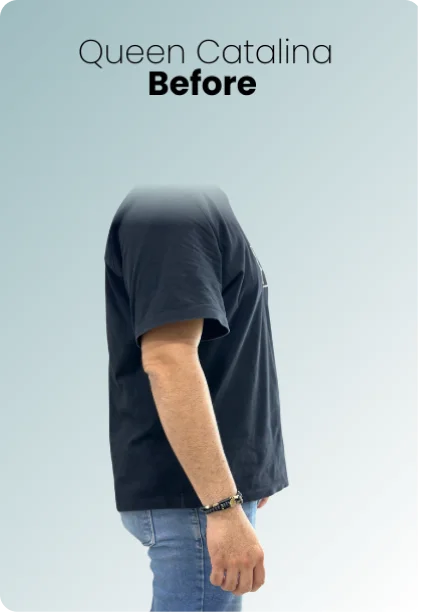 Gastric Balloon Procedure Img4 Queen Catalina