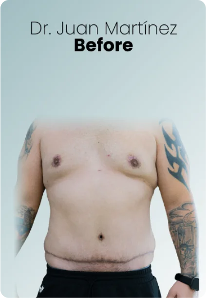 Gynecomastia Procedure Img1 Queen Catalina