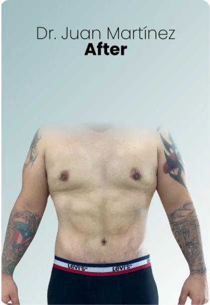 Gynecomastia Procedure Img2 Queen Catalina