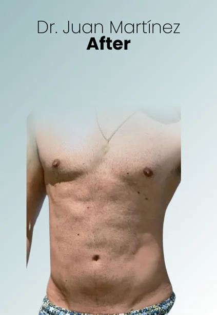 Gynecomastia Procedure Img4 Queen Catalina