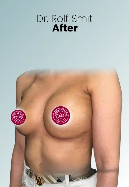 Implant Exchange Or Removal Procedure Img1 Queen Catalina