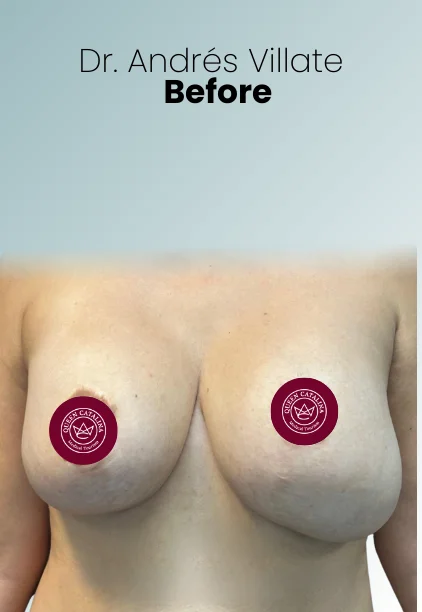 Implant Exchange Or Removal Procedure Img2 Queen Catalina