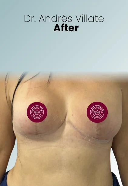 Implant Exchange Or Removal Procedure Img3 Queen Catalina