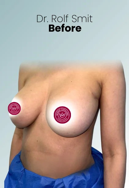 Implant Exchange Or Removal Procedure Img4 Queen Catalina