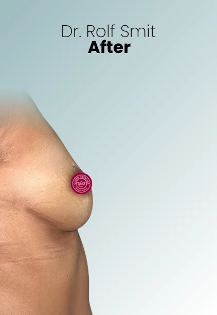 Implant Exchange Or Removal Procedure Img5 Queen Catalina