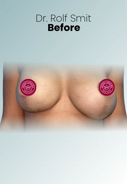 Implant Exchange Or Removal Procedure Img6 Queen Catalina