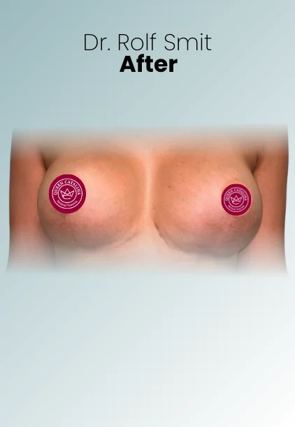 Implant Exchange Or Removal Procedure Img7 Queen Catalina