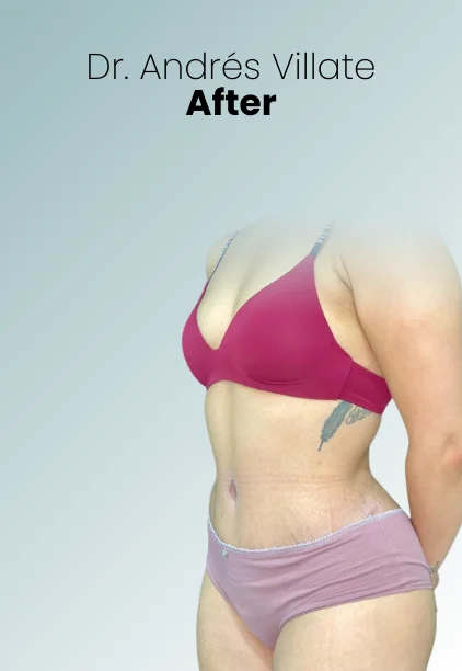 Liposuction Tech Procedure Img10 Queen Catalina