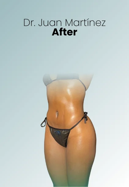 Liposuction Tech Procedure Img11 Queen Catalina