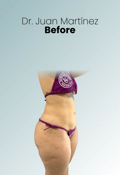 Liposuction Tech Procedure Img12 Queen Catalina