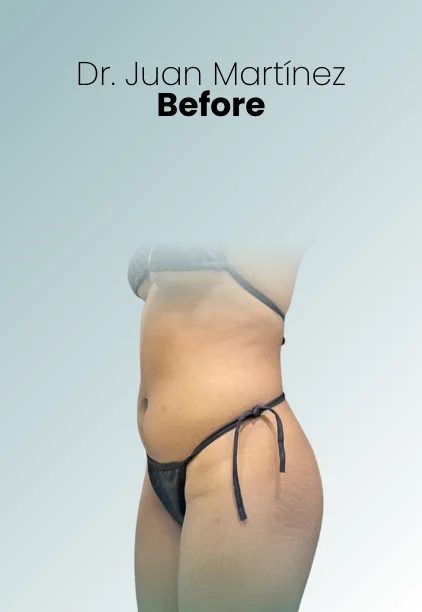 Liposuction Tech Procedure Img14 Queen Catalina