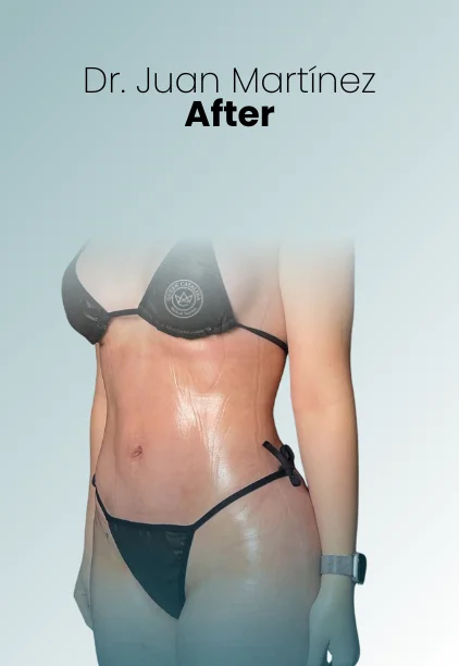 Liposuction Tech Procedure Img2 Queen Catalina