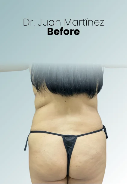 Liposuction Tech Procedure Img4 Queen Catalina