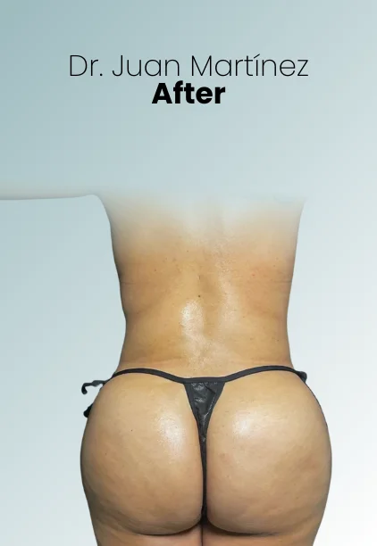 Liposuction Tech Procedure Img5 Queen Catalina