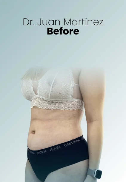 Liposuction Tech Procedure Img6 Queen Catalina