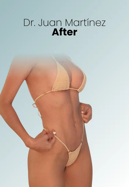 Liposuction Tech Procedure Img8 Queen Catalina