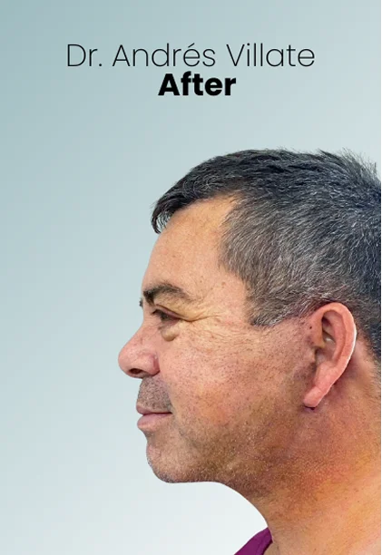 Male Facelift Procedure Img1 Queen Catalina