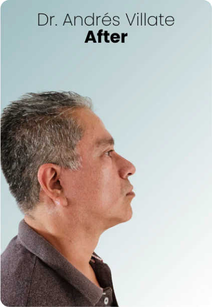 Male Facelift Procedure Img3 Queen Catalina