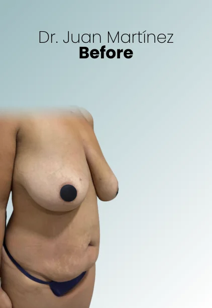 Mommy Makeover Procedure Img1 Queen Catalina