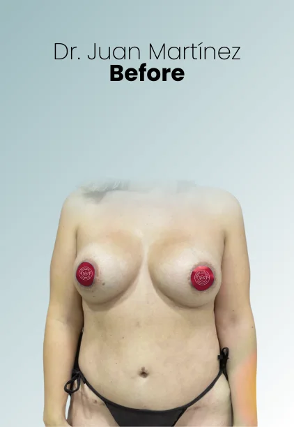 Mommy Makeover Procedure Img10 Queen Catalina