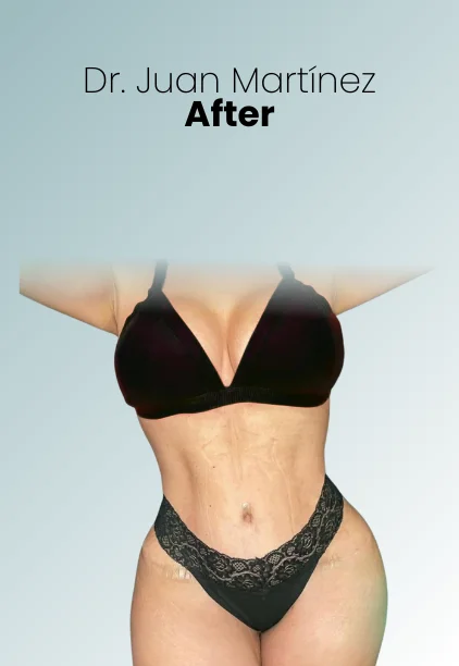 Mommy Makeover Procedure Img11 Queen Catalina