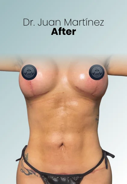 Mommy Makeover Procedure Img12 Queen Catalina