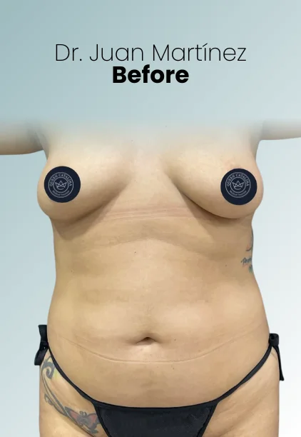 Mommy Makeover Procedure Img15 Queen Catalina