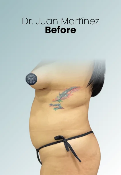 Mommy Makeover Procedure Img17 Queen Catalina