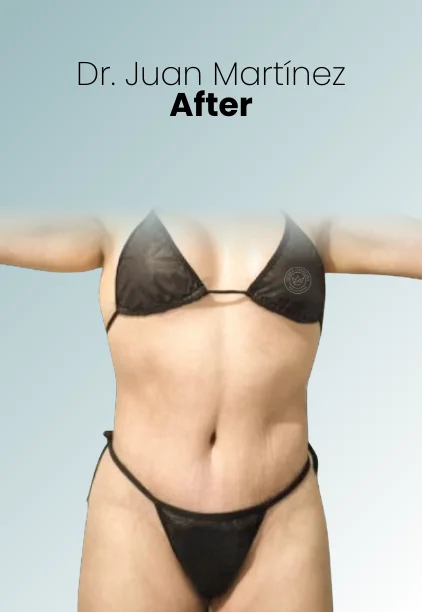 Mommy Makeover Procedure Img18 Queen Catalina