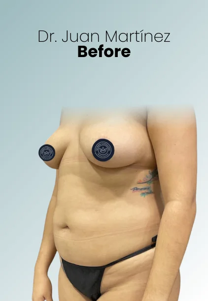 Mommy Makeover Procedure Img19 Queen Catalina