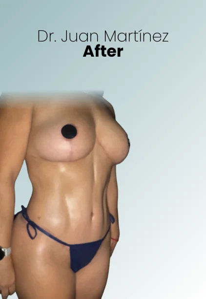 Mommy Makeover Procedure Img2 Queen Catalina