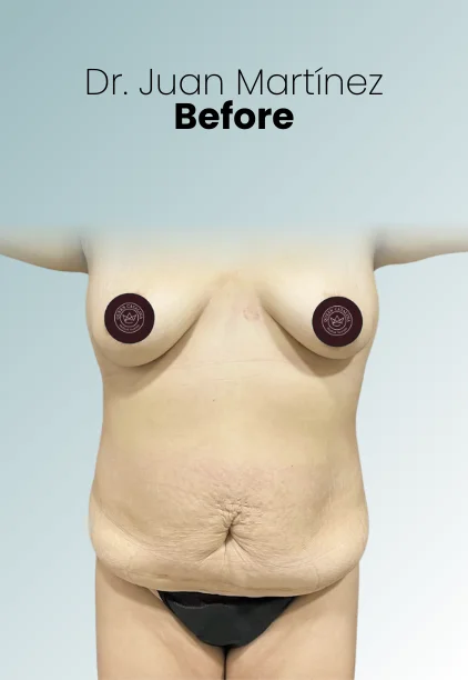 Mommy Makeover Procedure Img21 Queen Catalina