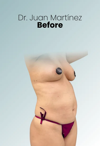 Mommy Makeover Procedure Img23 Queen Catalina