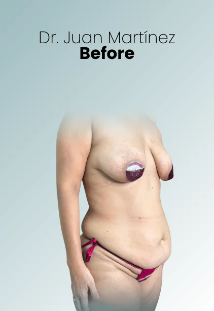 Mommy Makeover Procedure Img24 Queen Catalina