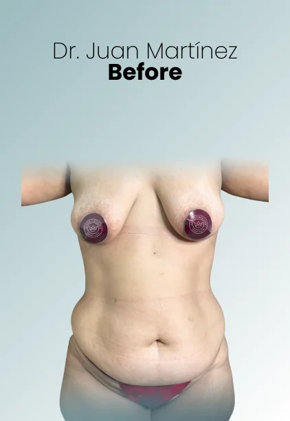 Mommy Makeover Procedure Img26 Queen Catalina