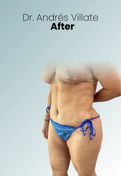 Mommy Makeover Procedure Img4 Queen Catalina