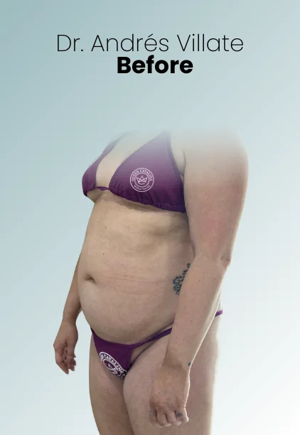 Mommy Makeover Procedure Img7 Queen Catalina