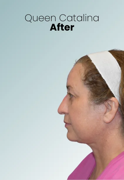 Neck Lift Procedure Img1 Queen Catalina