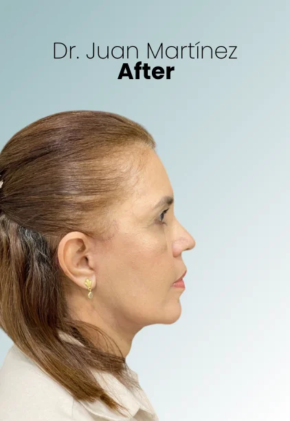 Neck Lift Procedure Img2 Queen Catalina