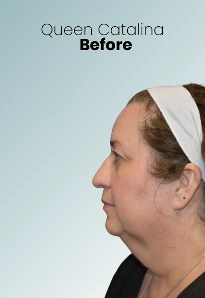 Neck Lift Procedure Img3 Queen Catalina